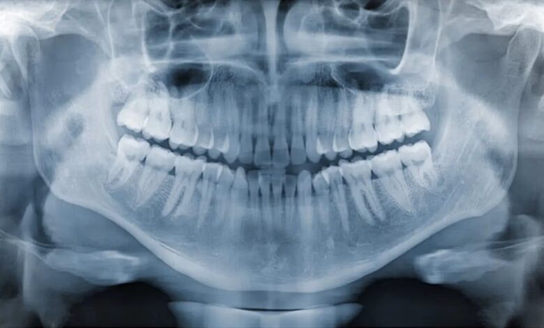 dental x rays